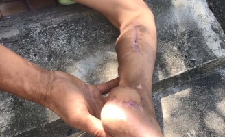 Bé 9 tuổi bị trầy chân nhưng điều trị thành 'què'