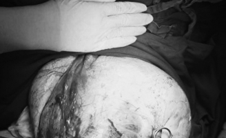 Bé gái mang khối u buồng trứng nặng 12 kg