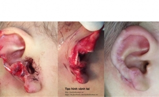 Bé trai 18 tháng tuổi bị chó dữ cắt nát vành tai