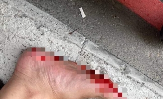 Đang đi đường bỗng dưng đổ máu vì vật thể lạ 