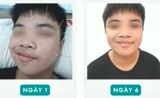 Ngủ dậy, nam sinh tá hỏa vì trúng 'khẩu nhãn oa tà'