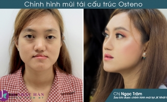 Người sứt môi hở hàm ếch sẽ có cơ hội được phẫu thuật miễn phí